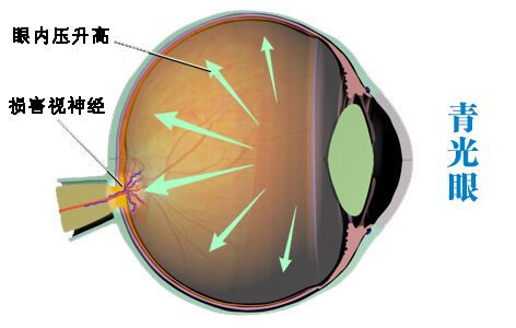 控制青光眼預(yù)防致盲的10大要點