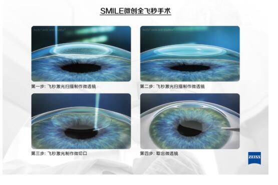 準(zhǔn)分子激光手術(shù)到底是怎么治 愈你的眼睛的？