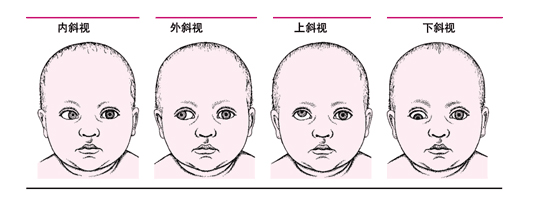 孩子有斜視做手術矯正有什么危險？