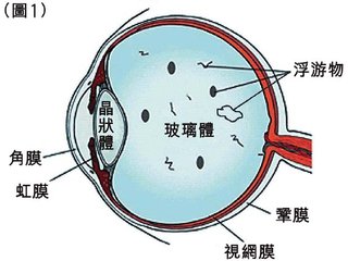 眼前有黑點飄，視物有些變形是什么眼病