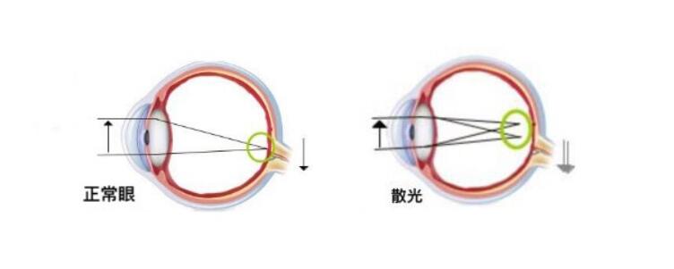 高度散光加近視可以做手術(shù)嗎？